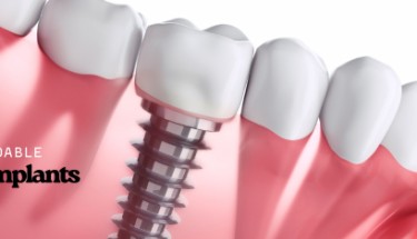 Programas Dentales Comunitarios en EE.UU. para Latinos sin Seguro: Oportunidades que Debes Conocer