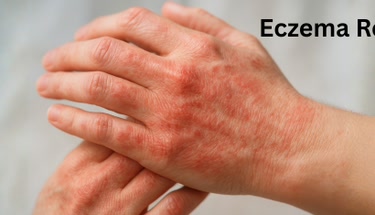 Practical Ways to Calm Eczema Itch: Proven Tips for Real Relief in 2025